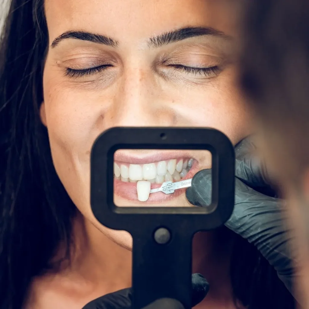 dental veneers in Dubai