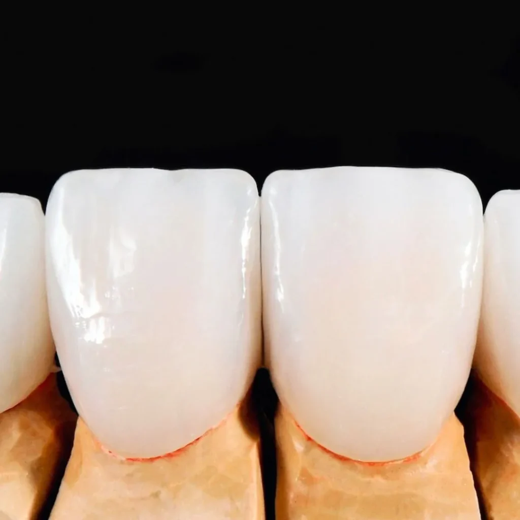 dental veneers in Dubai