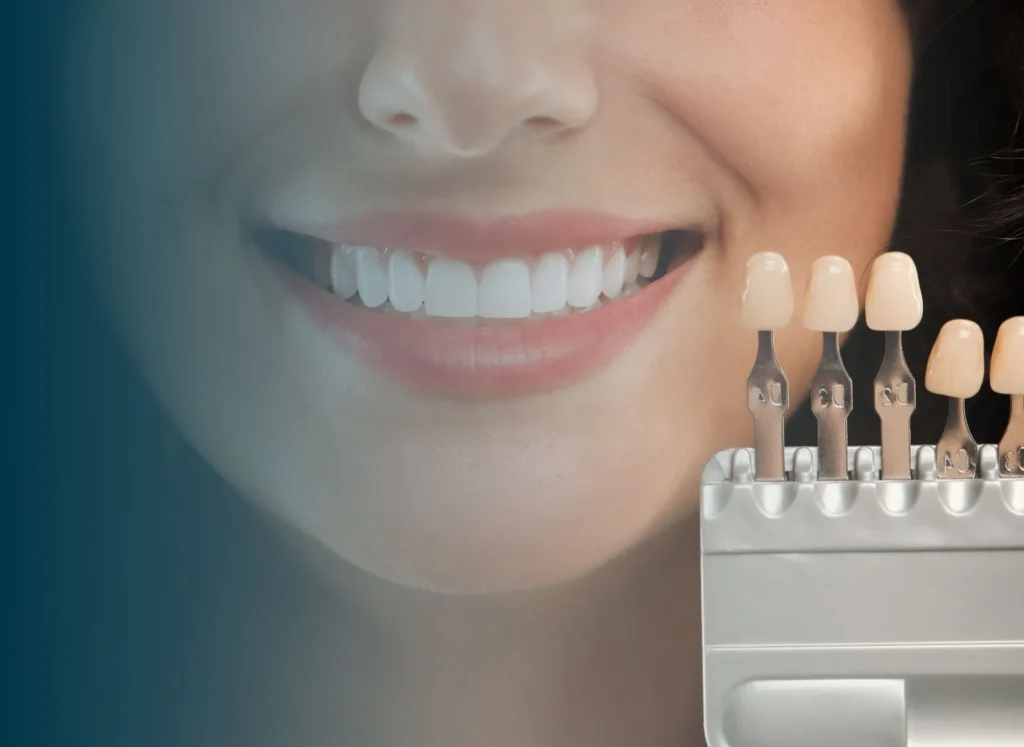 dental veneers in Dubai