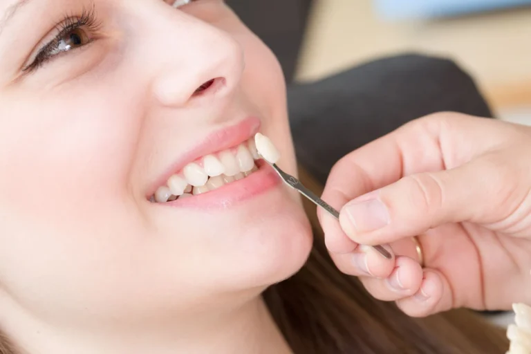 differences between dental veneers and crowns