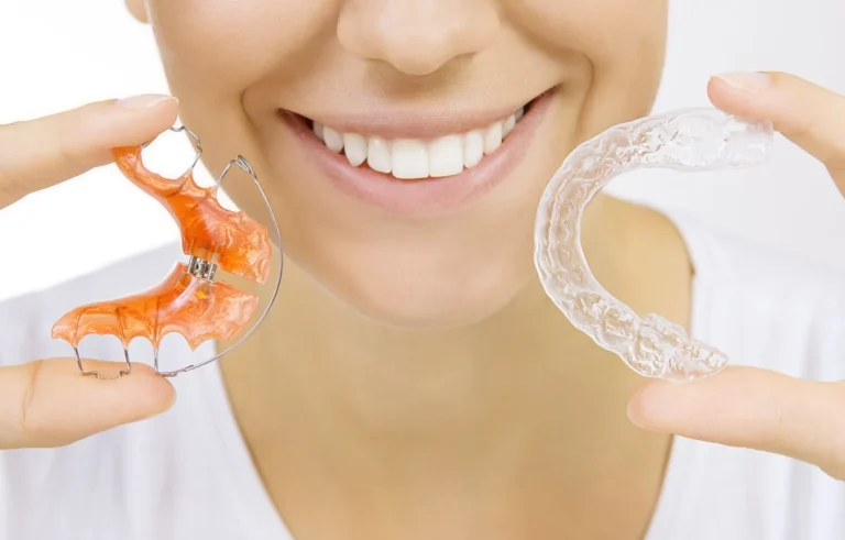 Differences between clear aligners and lingual braces