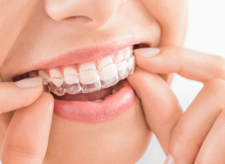 does invisalign work
